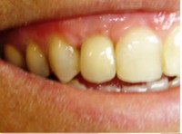 /album/galeria-de-fotos-carga-imediata-apos-exodontia-atraumatica-/carga-imediata-com-exodontia-atraumatica24-jpg/